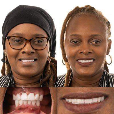 jax implants and dentures|JAX Dental Implants & Dentures 